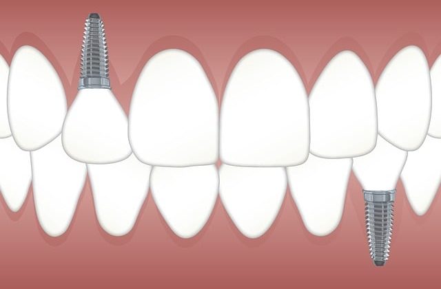 Are All On 4 Dental Implants Only For The Wealthy