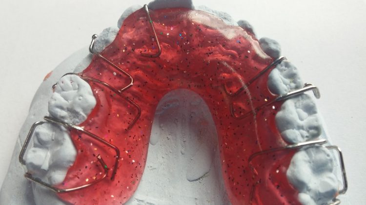 Things You Must Know Before Getting Braces